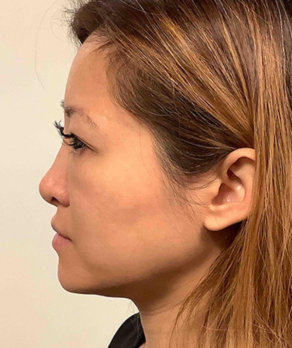 Morpheus8 Before & After Gallery - Patient 142880655 - Image 1