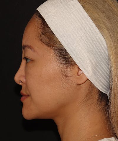 Sofwave Before & After Gallery - Patient 142880661 - Image 2