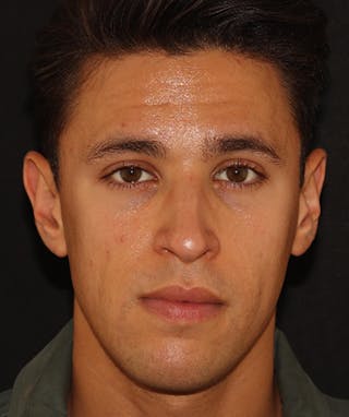 Morpheus8 Before & After Gallery - Patient 142880656 - Image 2