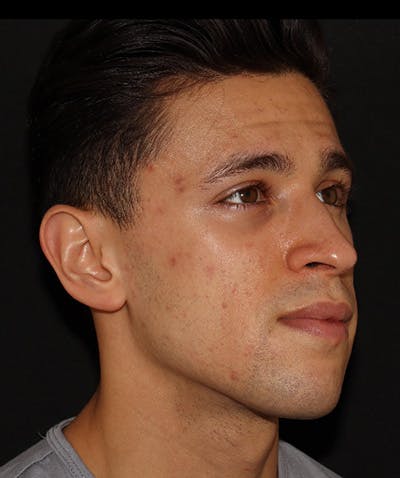 Morpheus8 Before & After Gallery - Patient 142880656 - Image 3
