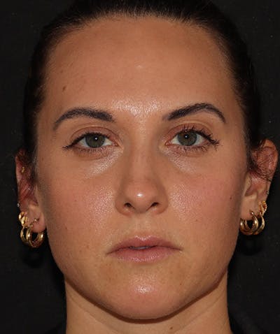 Restylane Before & After Gallery - Patient 142880680 - Image 1