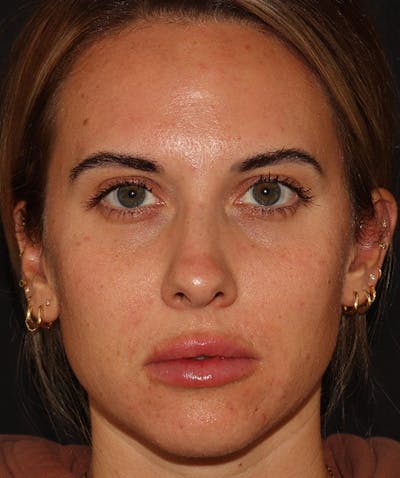 Restylane Before & After Gallery - Patient 142880680 - Image 2