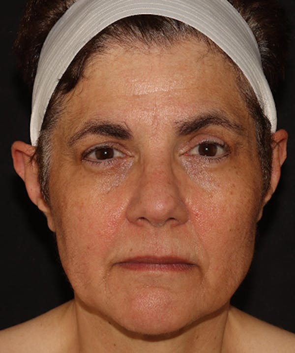 Facelift Before & After Gallery - Patient 142880683 - Image 1