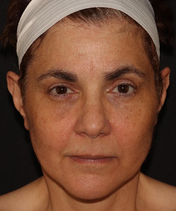 Facelift Before & After Gallery - Patient 142880683 - Image 2