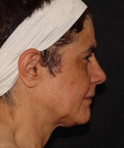 Facelift Before & After Gallery - Patient 142880683 - Image 3