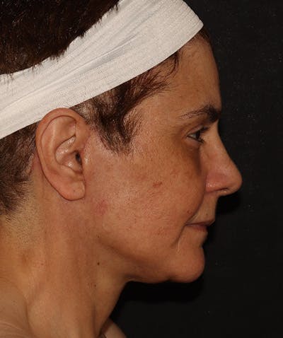 Facelift Before & After Gallery - Patient 142880683 - Image 4
