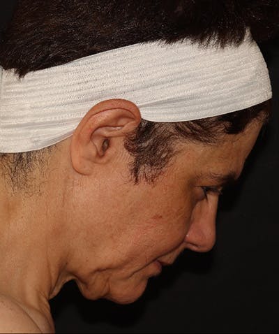 Facelift Before & After Gallery - Patient 142880683 - Image 5