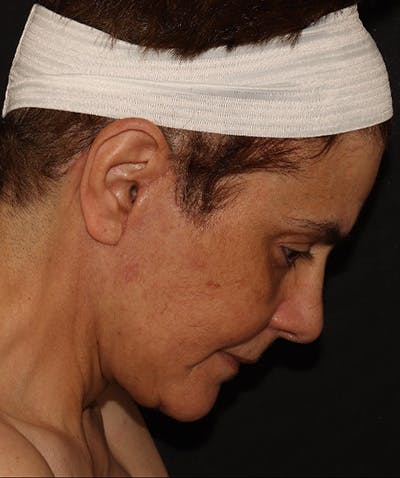 Facelift Before & After Gallery - Patient 142880683 - Image 6