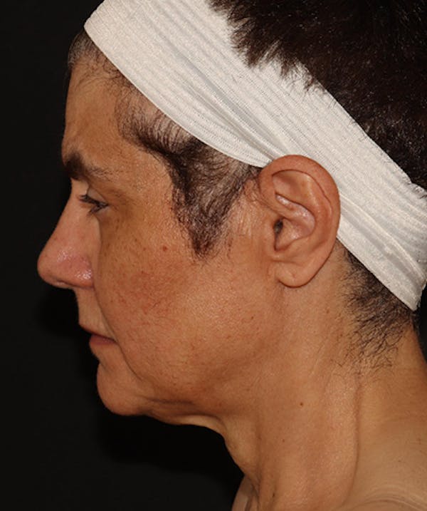 Facelift Before & After Gallery - Patient 142880683 - Image 7