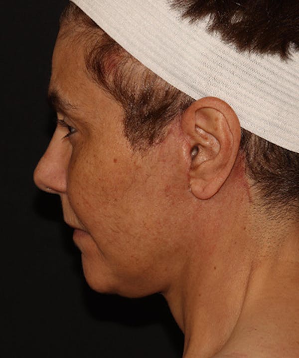 Facelift Before & After Gallery - Patient 142880683 - Image 8