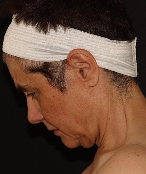 Facelift Before & After Gallery - Patient 142880683 - Image 9