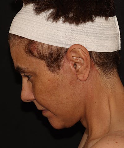 Facelift Before & After Gallery - Patient 142880683 - Image 10