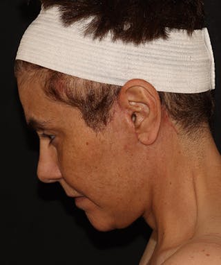 Facelift Before & After Gallery - Patient 142880683 - Image 10
