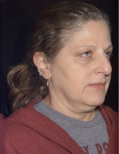 EMFACE Before & After Gallery - Patient 142926055 - Image 3
