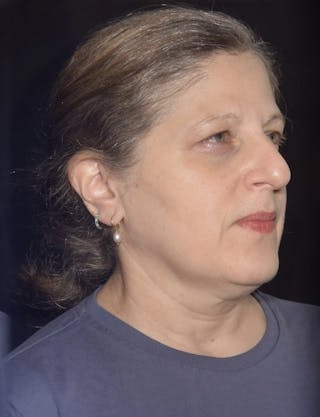 EMFACE Before & After Gallery - Patient 142926055 - Image 4