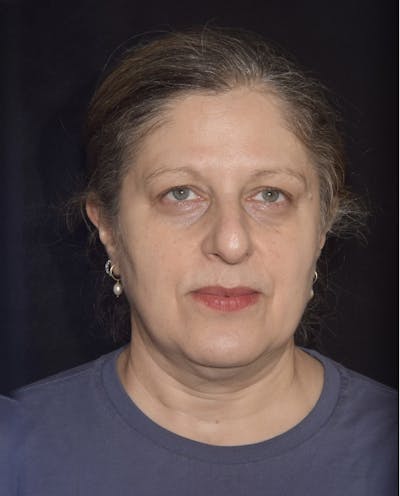 EMFACE Before & After Gallery - Patient 142926055 - Image 2