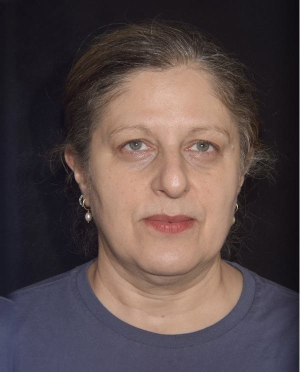 EMFACE Before & After Gallery - Patient 142926055 - Image 2