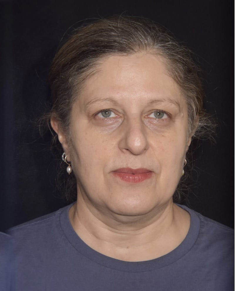 EMFACE Before & After Gallery - Patient 142926055 - Image 2