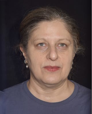 EMFACE Before & After Gallery - Patient 142926055 - Image 2