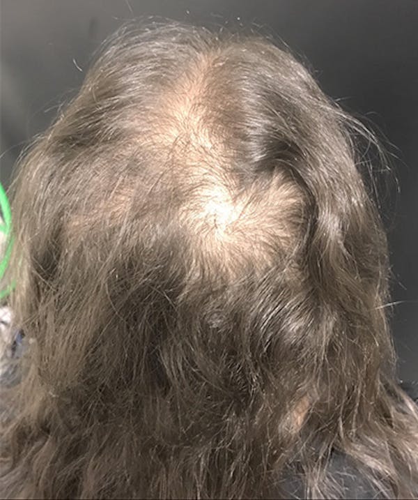 Non Surgical Hair Restoration Before & After Gallery - Patient 143397940 - Image 1