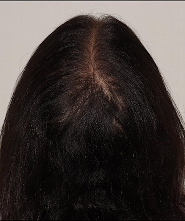 Non Surgical Hair Restoration Before & After Gallery - Patient 143397940 - Image 2