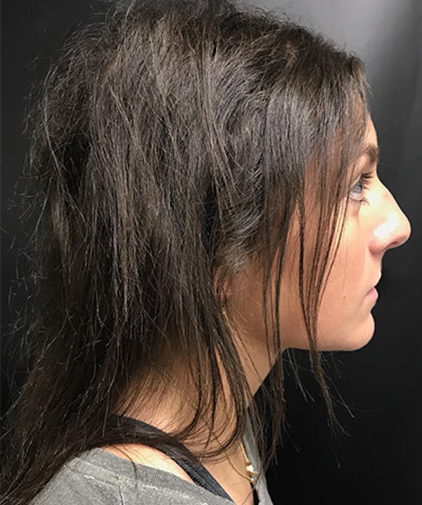 Non Surgical Hair Restoration Before & After Gallery - Patient 143397940 - Image 3