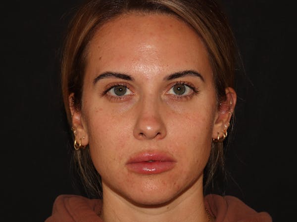 Lip Filler Before & After Gallery - Patient 143617242 - Image 2