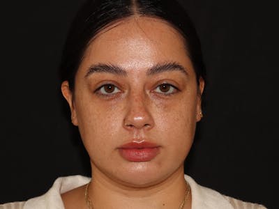 Lip Filler Before & After Gallery - Patient 143617243 - Image 1
