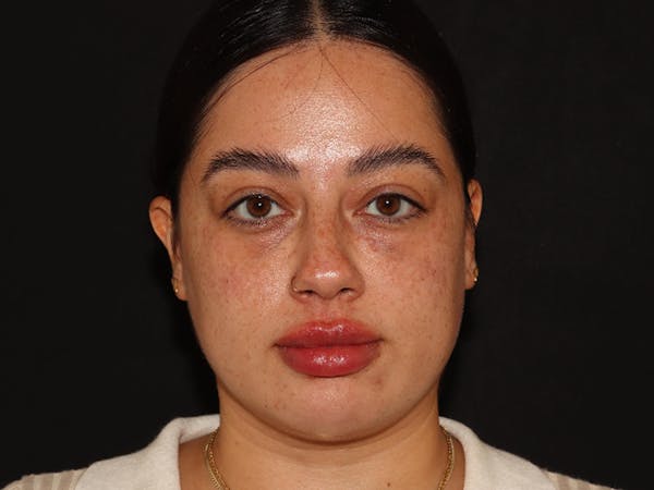 Lip Filler Before & After Gallery - Patient 143617243 - Image 2