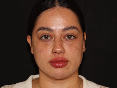 Lip Filler Before & After Gallery - Patient 143617243 - Image 2