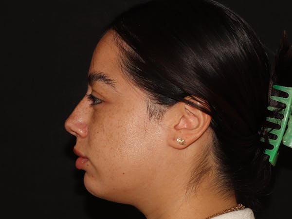 Lip Filler Before & After Gallery - Patient 143617243 - Image 5