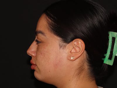 Lip Filler Before & After Gallery - Patient 143617243 - Image 6