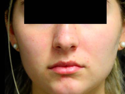 Lip Filler Before & After Gallery - Patient 143617244 - Image 1