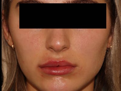 Lip Filler Before & After Gallery - Patient 143617244 - Image 2