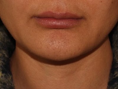 Lip Filler Before & After Gallery - Patient 143617245 - Image 1