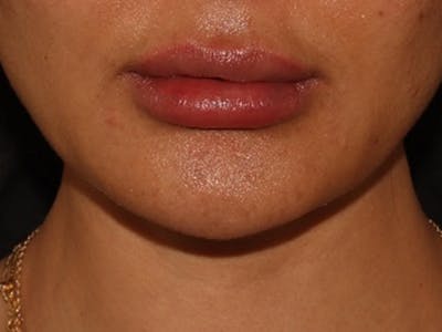 Lip Filler Before & After Gallery - Patient 143617245 - Image 2