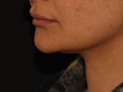 Lip Filler Before & After Gallery - Patient 143617245 - Image 3
