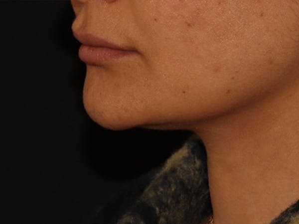 Lip Filler Before & After Gallery - Patient 143617245 - Image 3