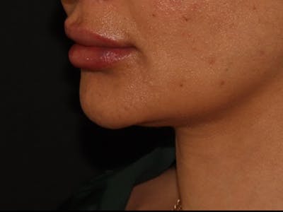 Lip Filler Before & After Gallery - Patient 143617245 - Image 4