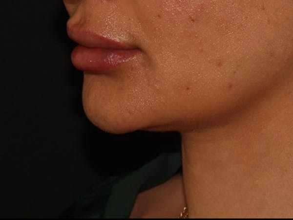 Lip Filler Before & After Gallery - Patient 143617245 - Image 4