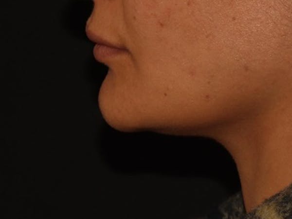 Lip Filler Before & After Gallery - Patient 143617245 - Image 5