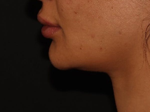 Lip Filler Before & After Gallery - Patient 143617245 - Image 6