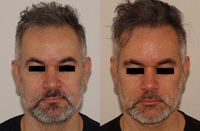 Hair Transplant Before & After Gallery - Patient 144541983 - Image 2