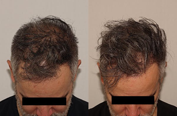 Hair Transplant Before & After Gallery - Patient 144541983 - Image 1
