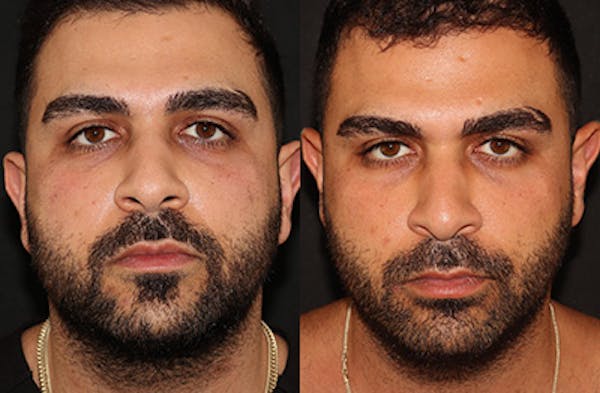 Buccal Fat Removal Before & After Gallery - Patient 144542034 - Image 1