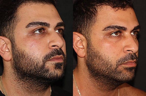 Buccal Fat Removal Before & After Gallery - Patient 144542034 - Image 2