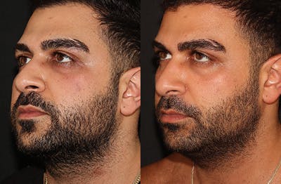 Buccal Fat Removal Before & After Gallery - Patient 144542034 - Image 3