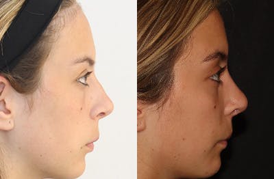 Rhinoplasty Before & After Gallery - Patient 144542039 - Image 1