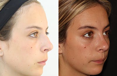 Rhinoplasty Before & After Gallery - Patient 144542039 - Image 2