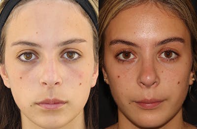 Rhinoplasty Before & After Gallery - Patient 144542039 - Image 3